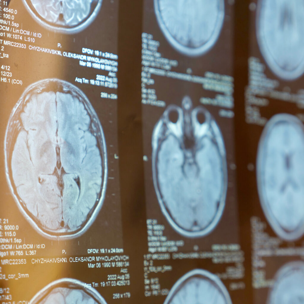 MRI Of The Human Brain MRI brain scan images displaying cross-sectional views for medical analysis.
