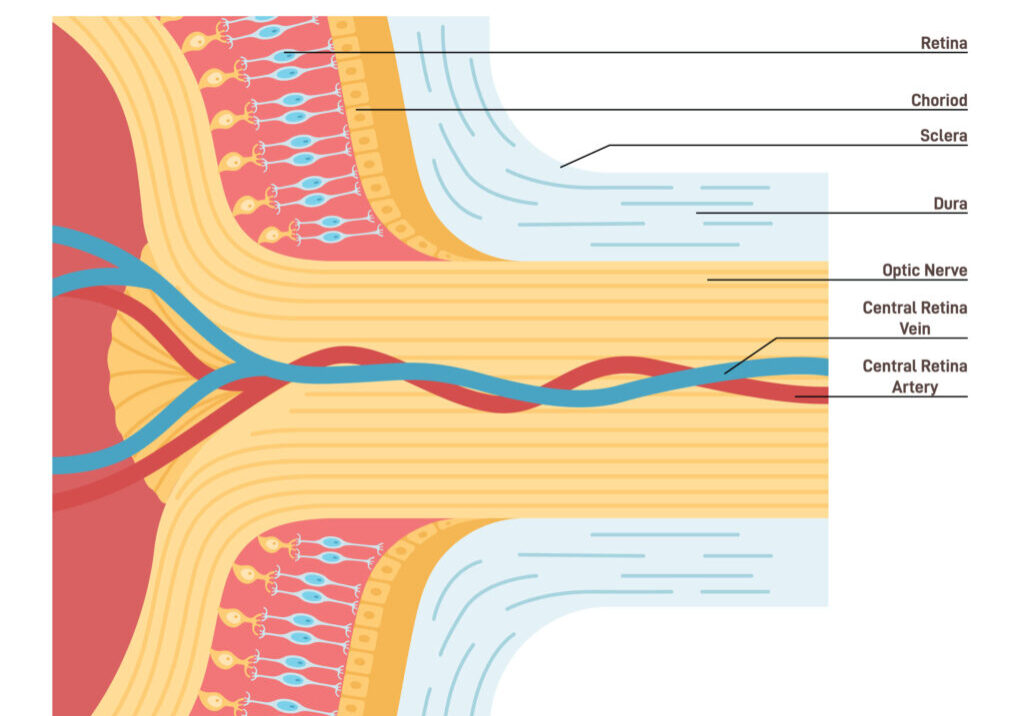 Chadwick Vision Clinic Optic Nerve Structure Diagram Diagram of optic nerve structure showing retina, choroid, sclera, dura, central retina vein, and artery.
